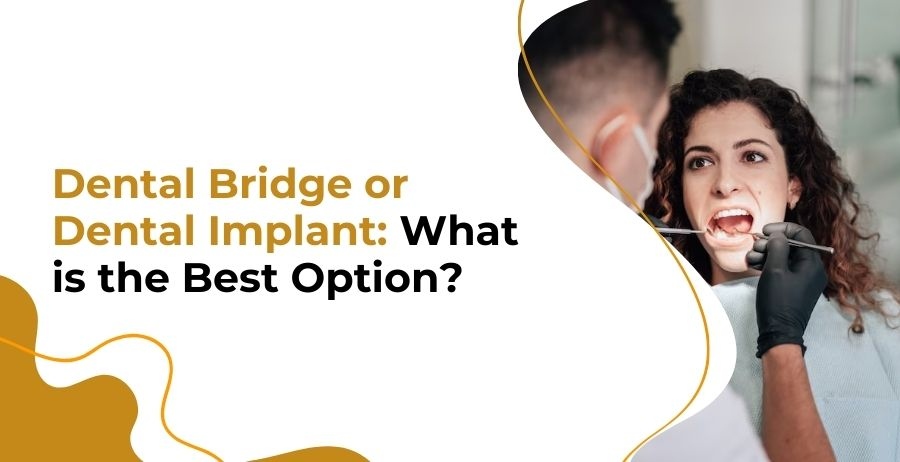 Dental Bridge Or Dental Implant: What Is The Best Option